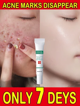 Crema para eliminar el acné y las marcas de acné, extracto de hierbas, eficaz, antiinflamatoria, reparación de la piel, control