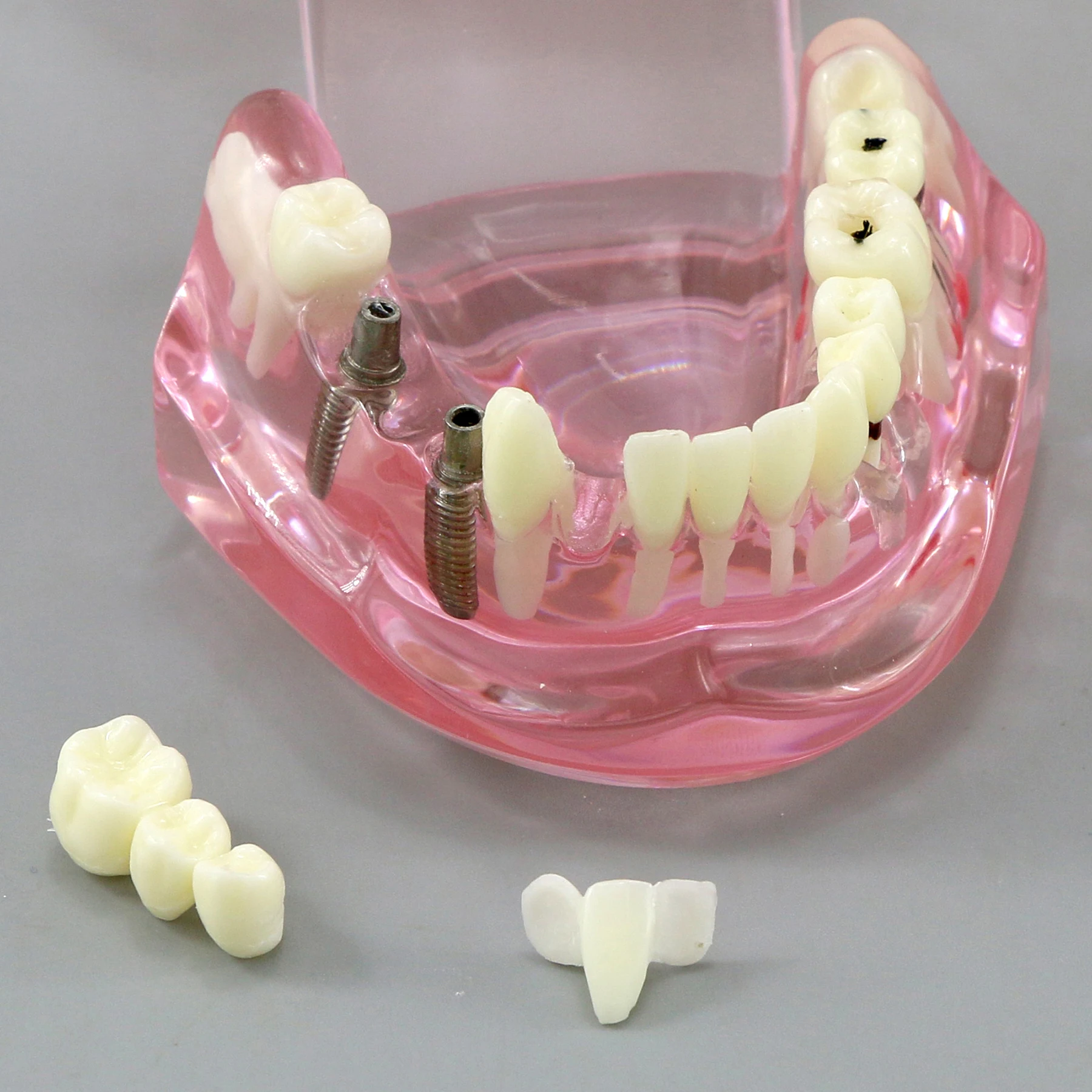 Model Gigi Penyakit Implan Gigi Perbaikan Gigi untuk Pengajaran Praktik Dokter Gigi Belajar Demo Kedokteran Gigi Mulut - 4