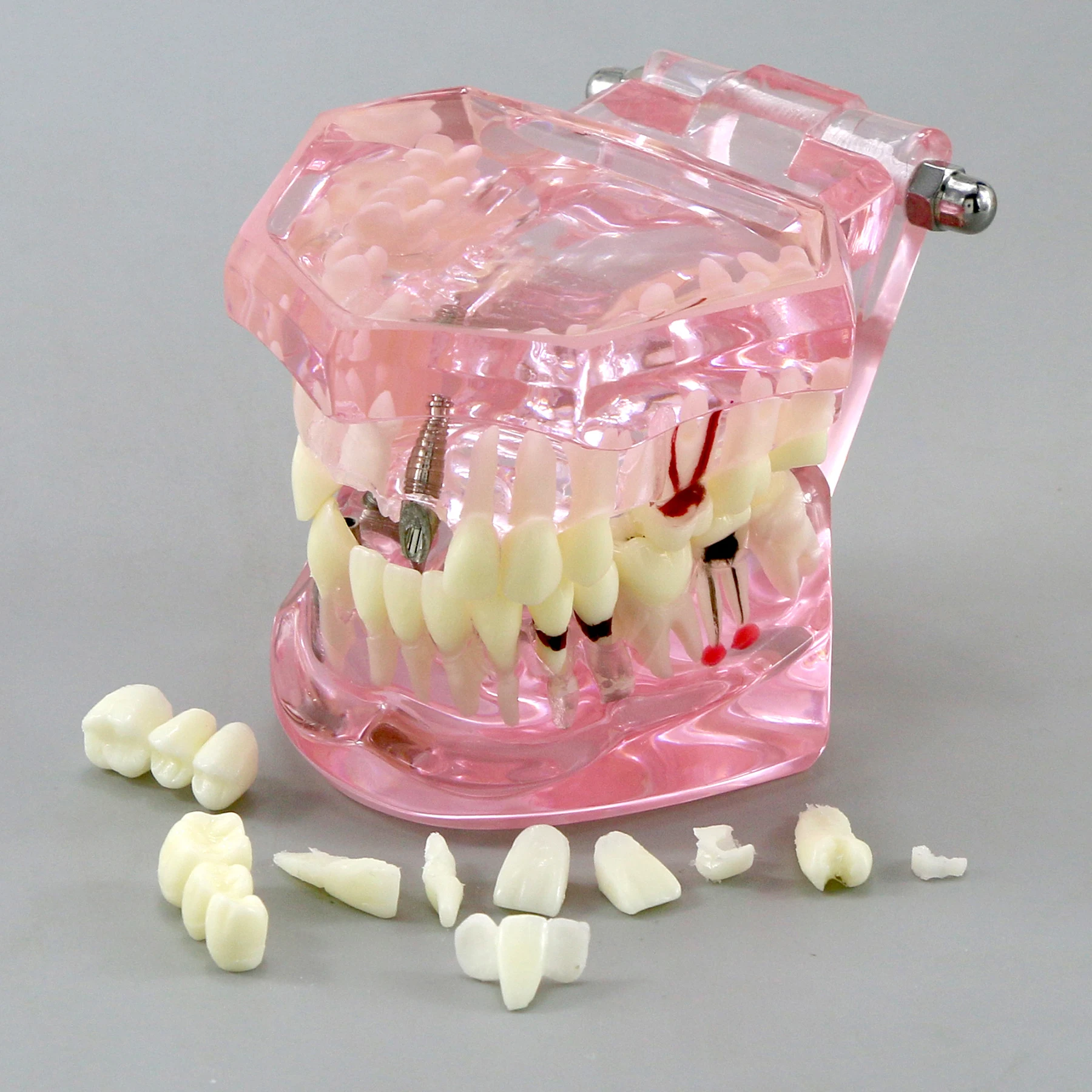 Model Gigi Penyakit Implan Gigi Perbaikan Gigi untuk Pengajaran Praktik Dokter Gigi Belajar Demo Kedokteran Gigi Mulut - 5